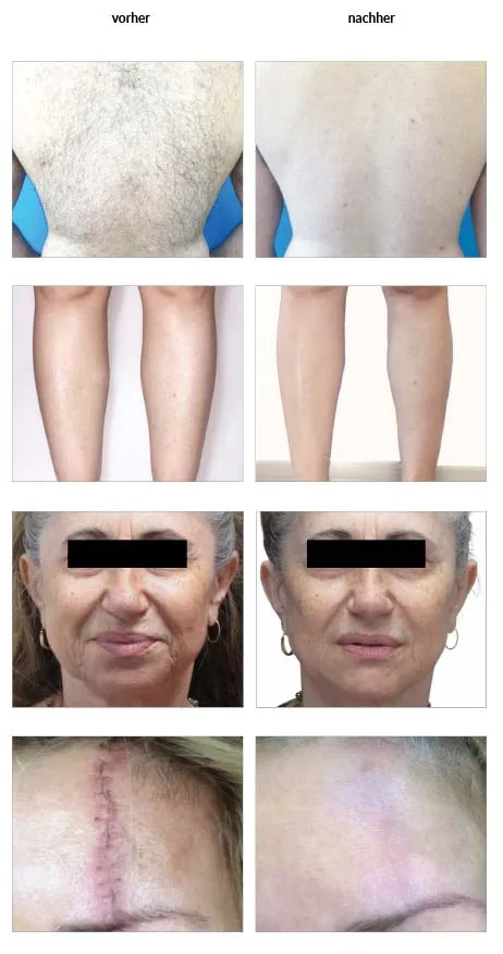 Venus viva Aknenarben Verbesserung der Hautstruktur plus Hautstraffung