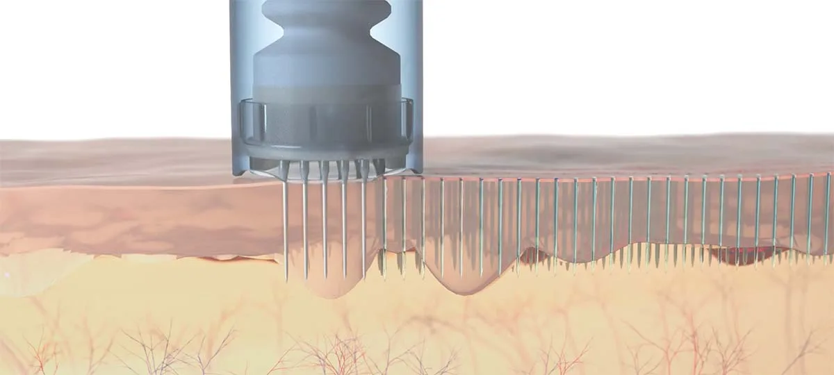 DERMAPEN – Medizinisches Microneedling