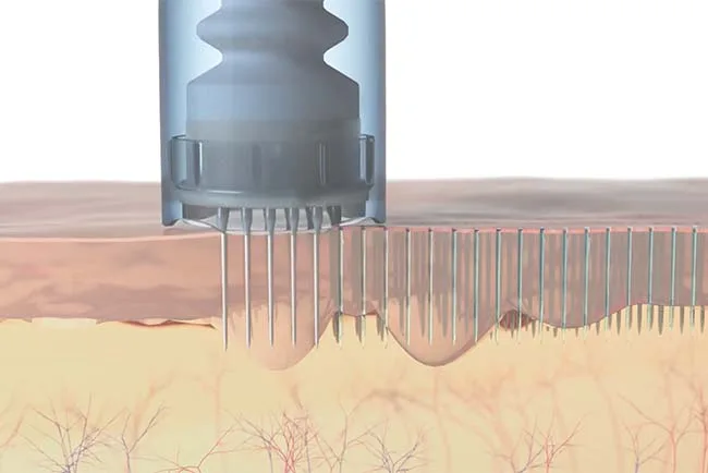 DERMAPEN – Medizinisches Microneedling