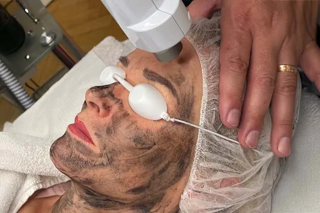 Laser Carbon Peeling – Hollywood Peeling