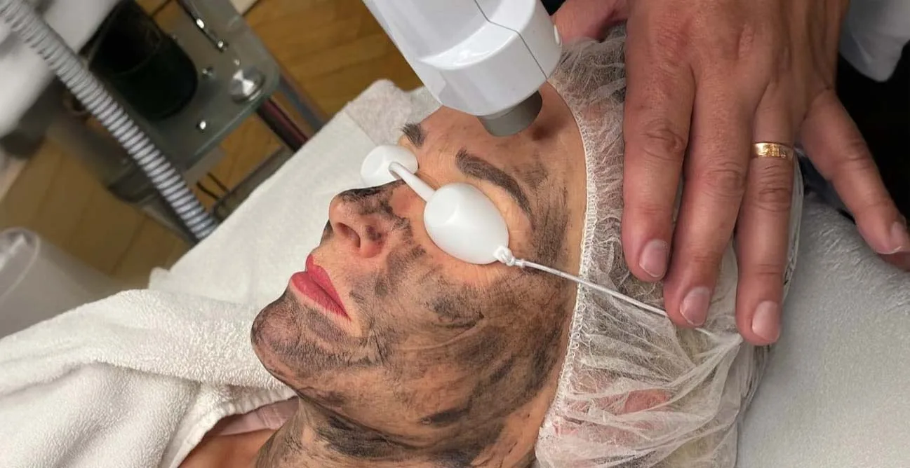 Laser Carbon Peeling – Hollywood Peeling